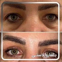 شد الجفن: الحل الآمن للتخلص من الترهل واستعادة جمال العيون