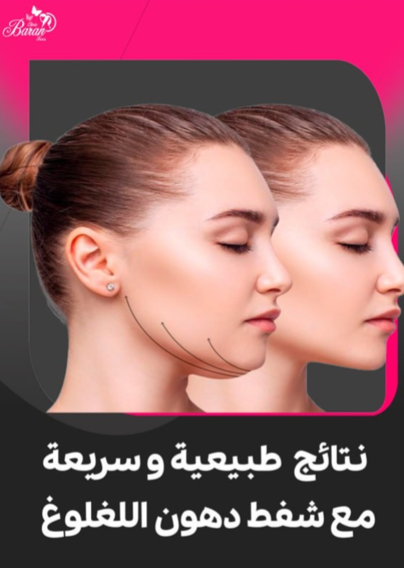 شفط دهون اللقلوق: الحل الأمثل لإبراز جمال الوجه