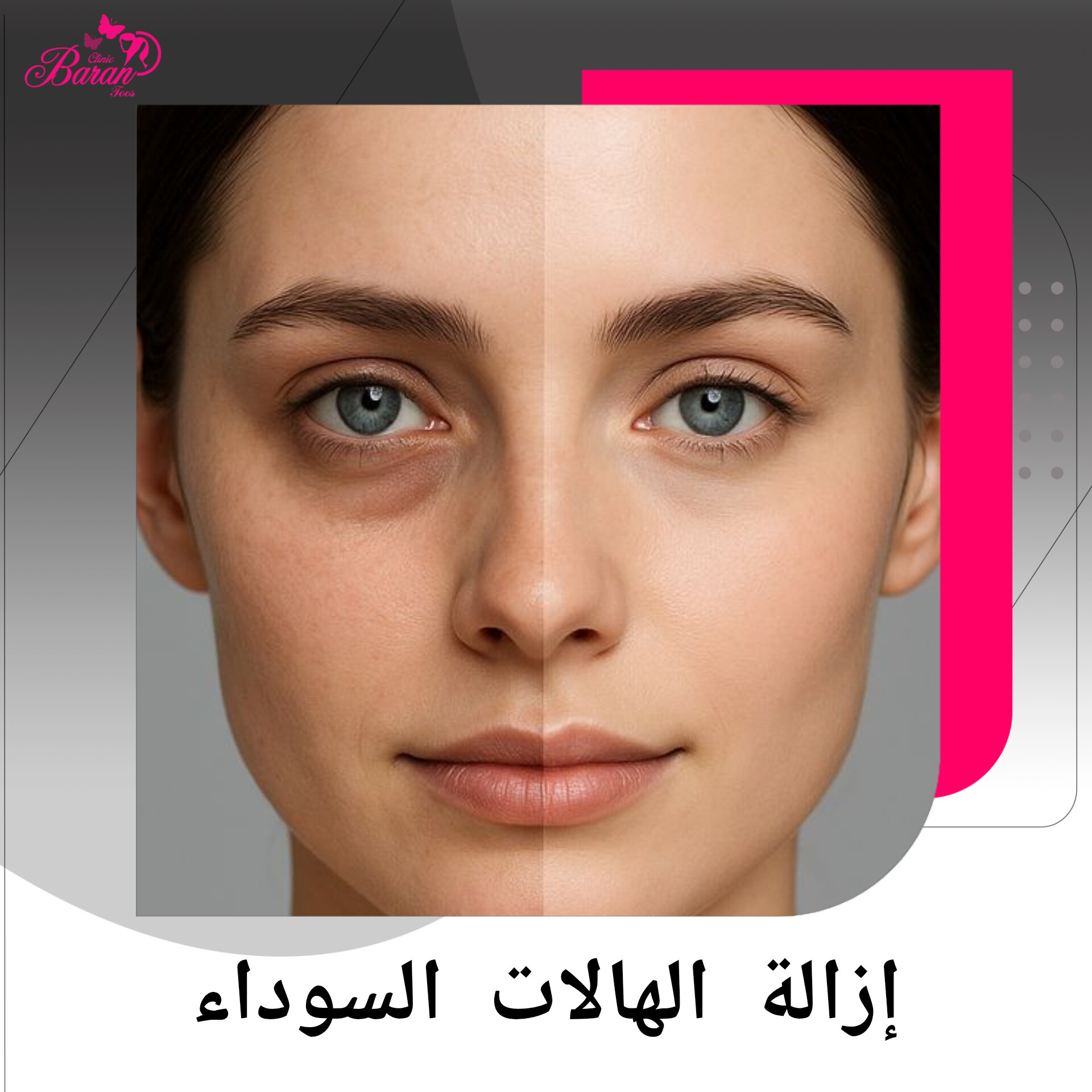 تفتيح الجسم والهالات السوداء بالكاربوكسي ثيرابي