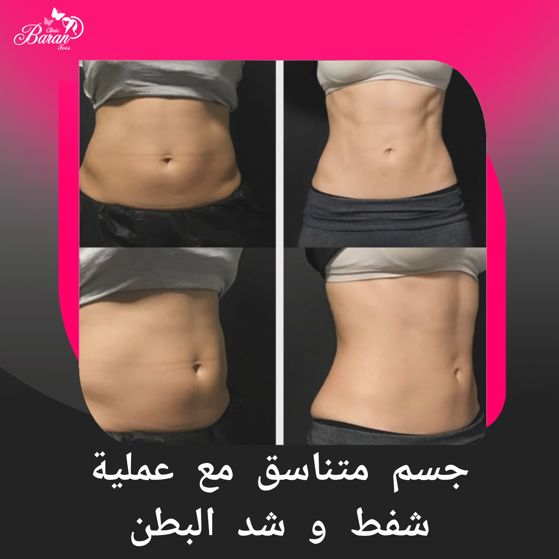 بطن مشدود وجسم متناسق مع أحدث تقنيات شفط وشد البطن