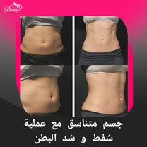 بطن مشدود وجسم متناسق مع أحدث تقنيات شفط وشد البطن