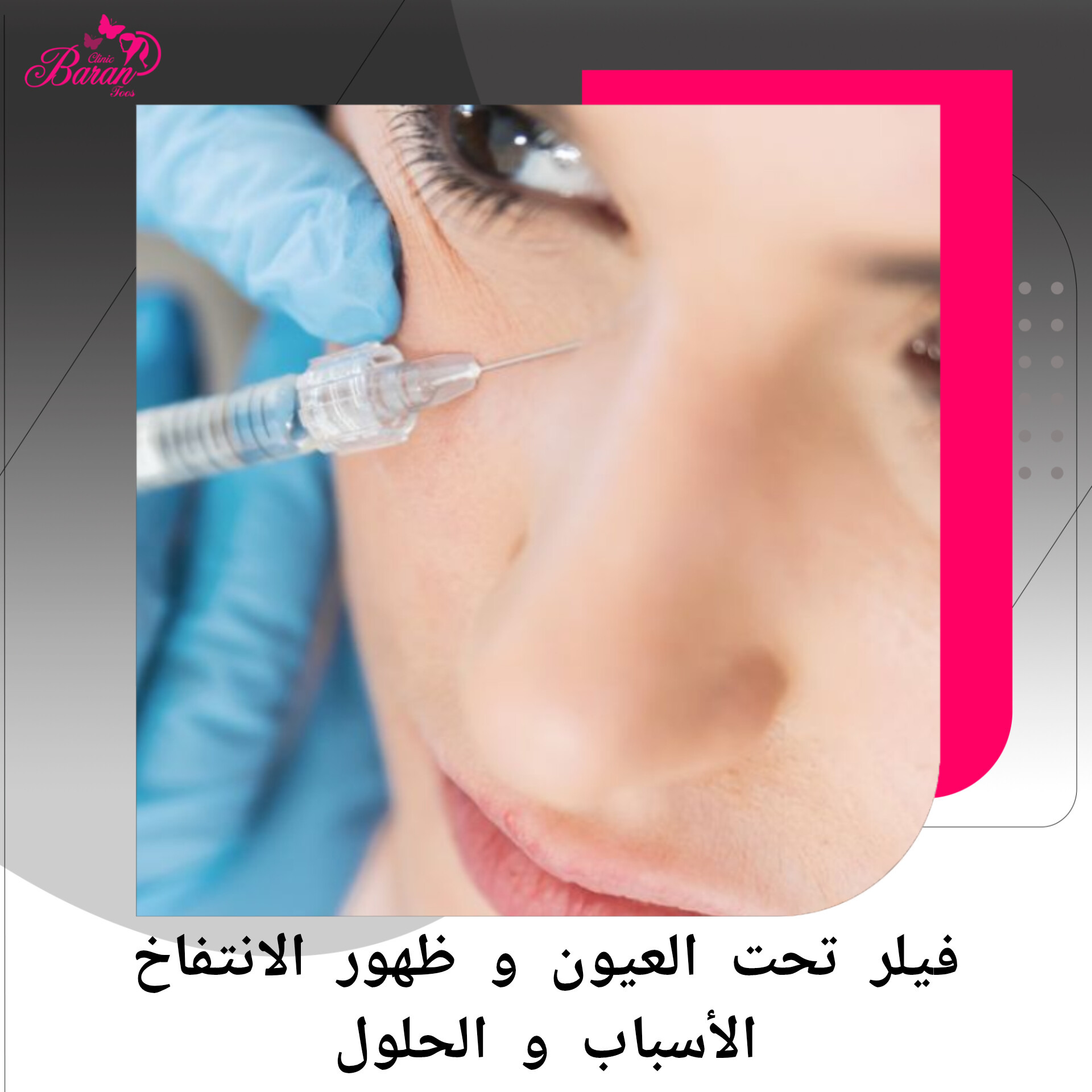 فيلر تحت العين و ظهور الانتفاخ... الأسباب و الحلول