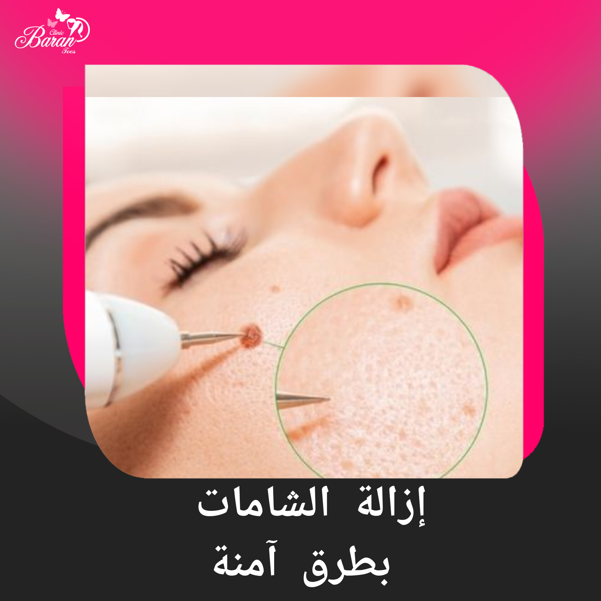 إزالة الشامات بطرق آمنة وفعّالة