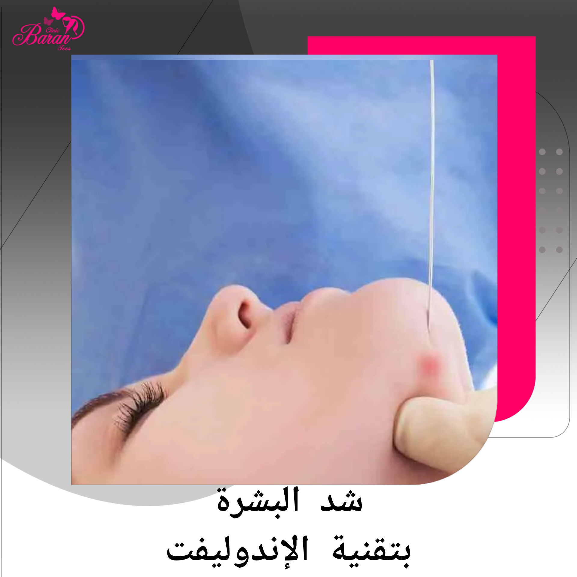 الإندولیفت: تقنية متقدمة لشد الوجه والرقبة بدون جراحة