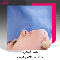 الإندولیفت: تقنية متقدمة لشد الوجه والرقبة بدون جراحة