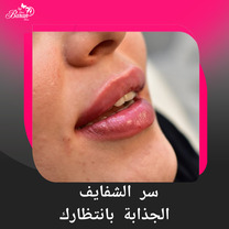 شفايف متناسقة وطبيعية مع حقن الفيلر في عيادة باران توس