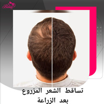 تساقط الشعر المزروع في الشهر الأول: أسباب طبيعية وإرشادات هامة