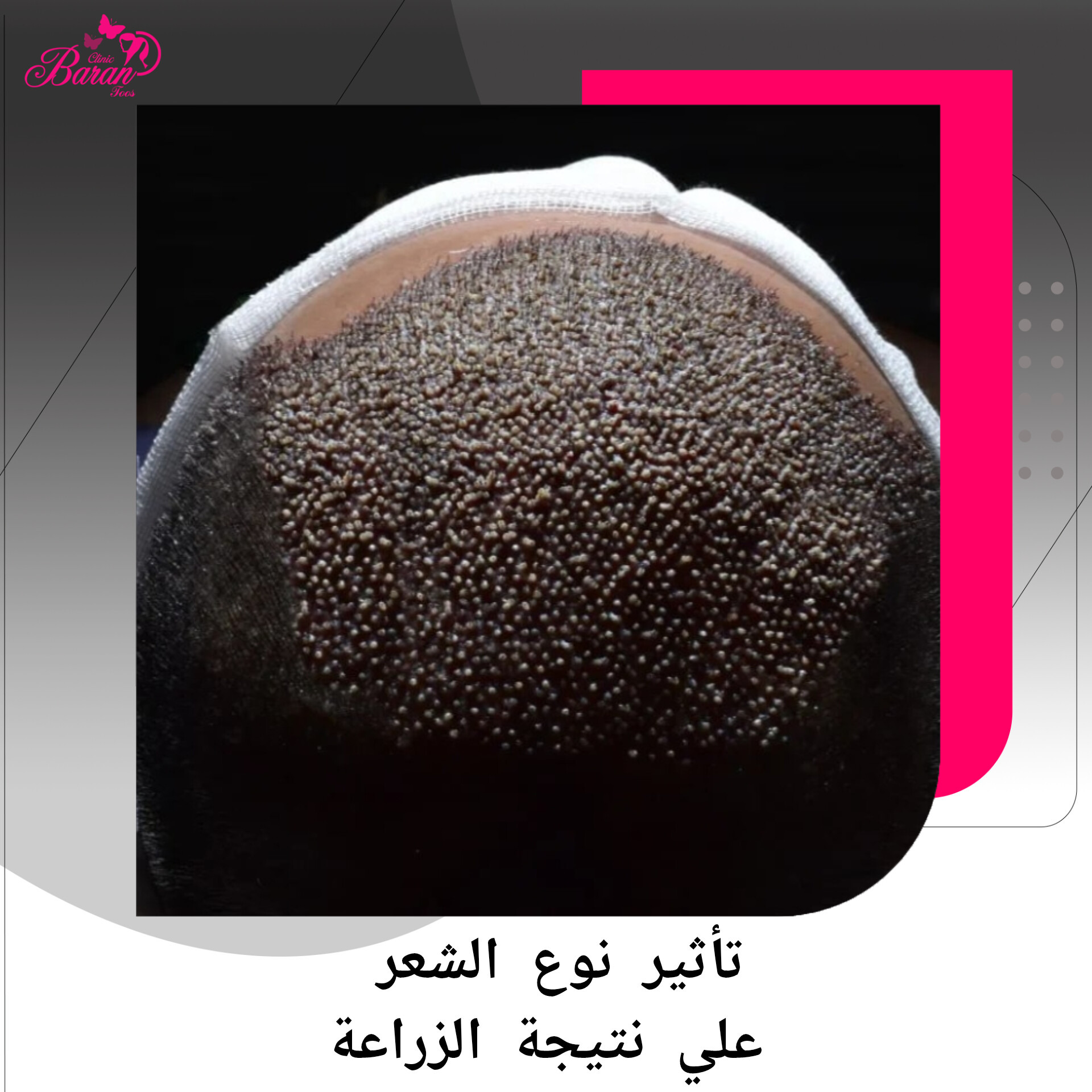 هل نوع الشعر يؤثر على نتائج زراعة الشعر؟ دليل عيادة باران توس الشامل