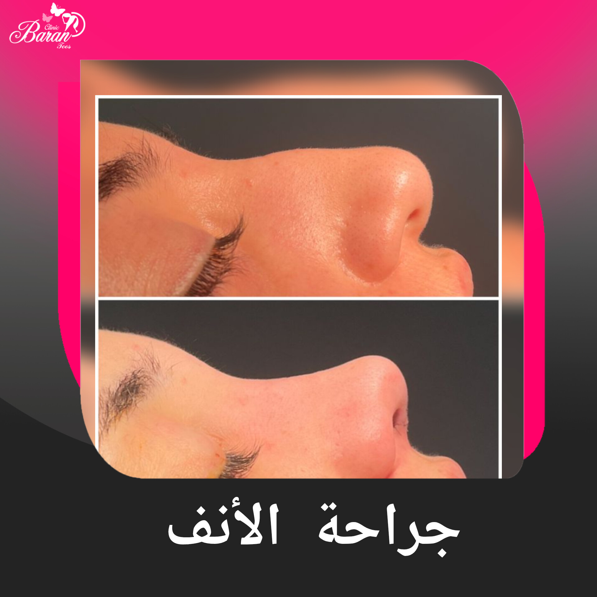 جراحة الأنف: دليلك الشامل للحصول على أنف طبيعي ومتناسق