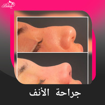 جراحة الأنف: دليلك الشامل للحصول على أنف طبيعي ومتناسق