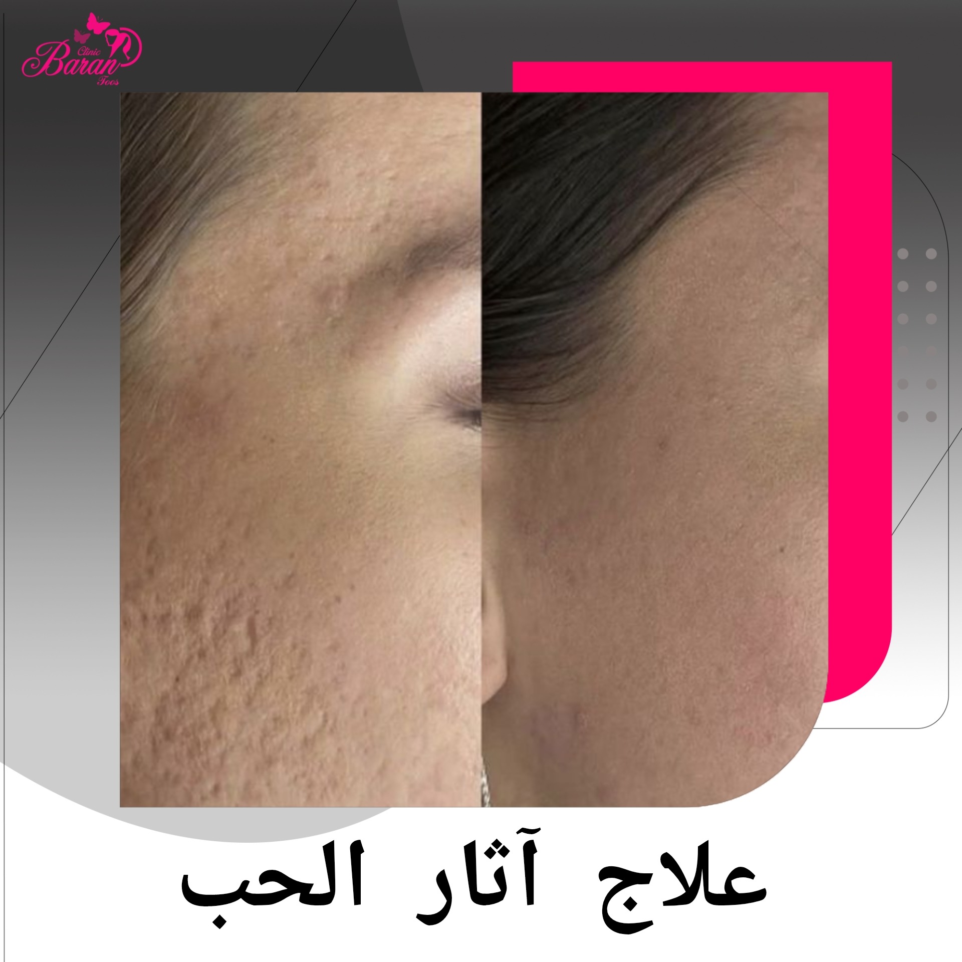 أفضل طرق علاج آثار حبّ الشباب
