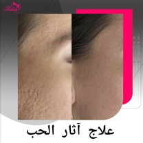 أفضل طرق علاج آثار حبّ الشباب