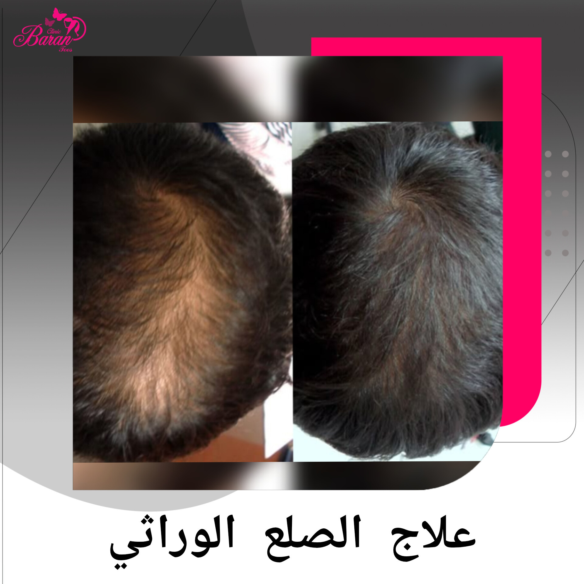علاج الصلع الوراثي في باران توس