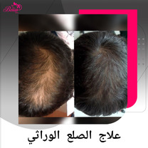 علاج الصلع الوراثي في باران توس