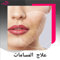 المسام الواسعة: الأسباب، الحقيقة الطبية، وأحدث طرق العلاج
